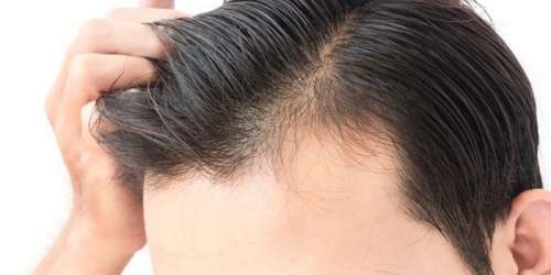 Advices on Hair Transplantation